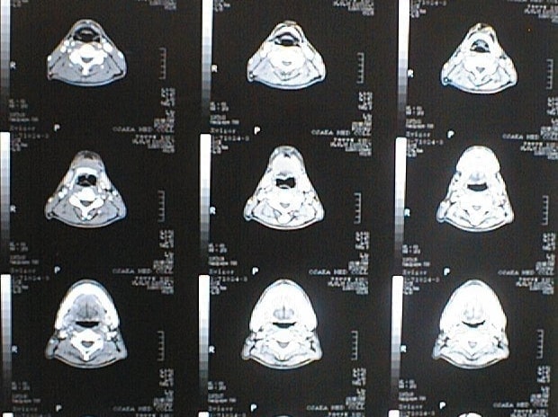 中咽頭末期がん消滅CT画像①