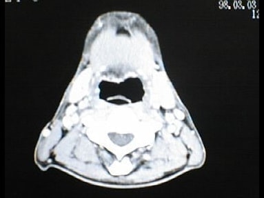 中咽頭末期がん消滅CT画像③