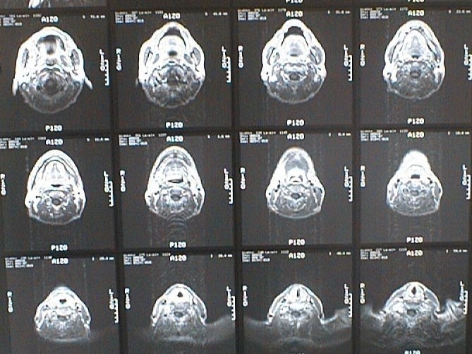 中咽頭末期がん消滅時MRI画像①