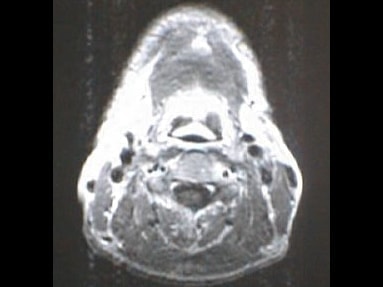 中咽頭末期がん消滅時MRI画像②