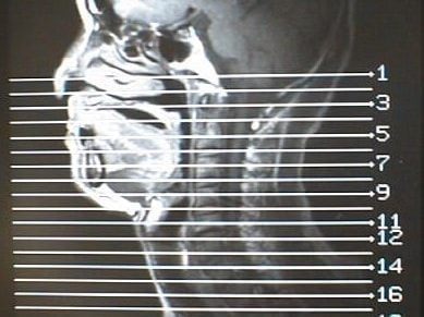 中咽頭末期がんMRI画像④