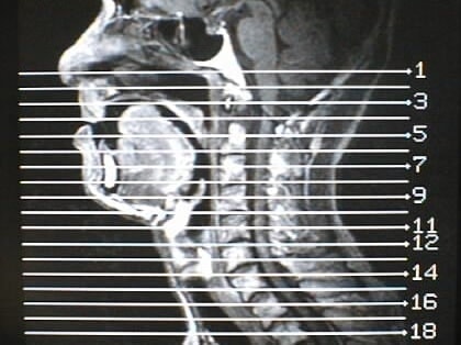 中咽頭末期がん消滅時MRI画像④
