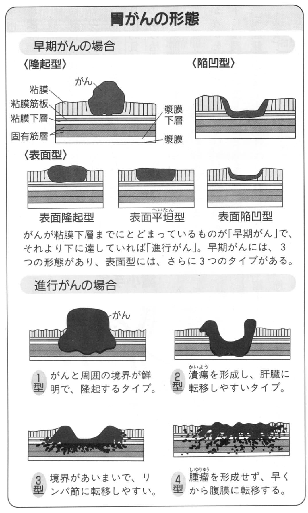 胃がんの形態