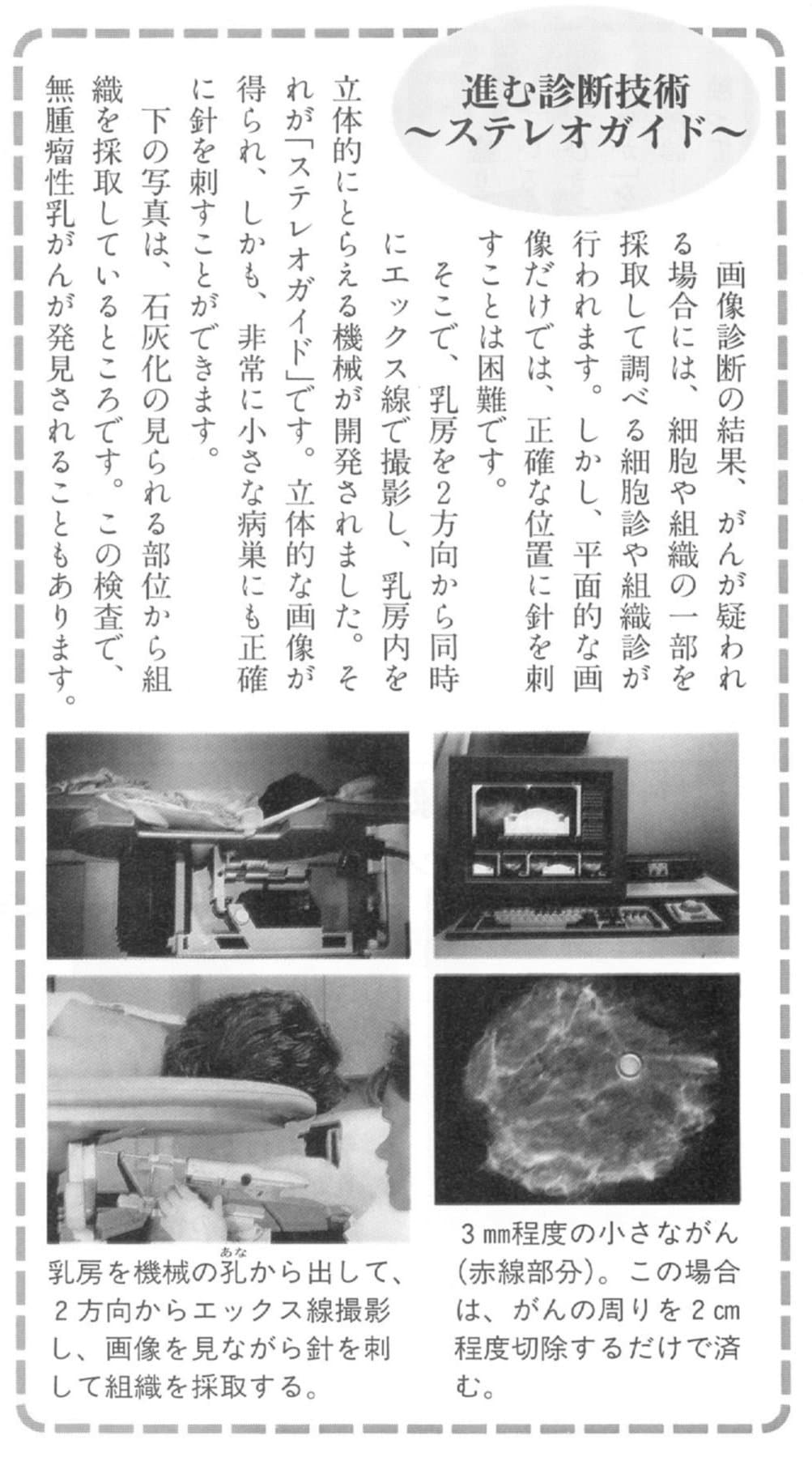 乳がんのステレオガイド