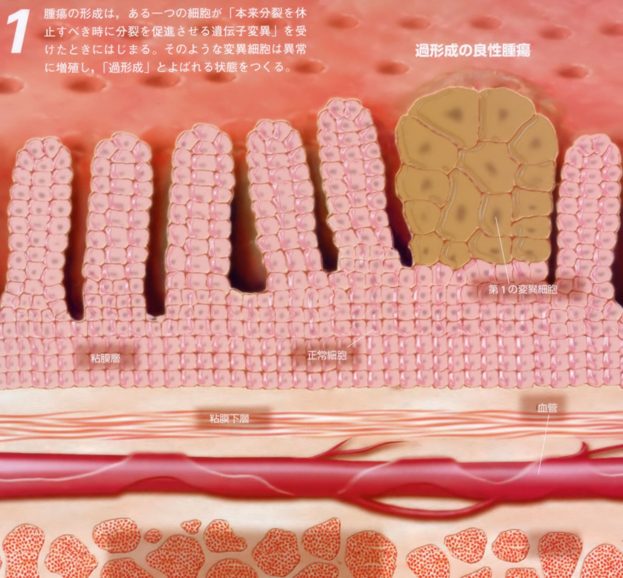 過形成の良性腫瘍(末期癌からの生還)