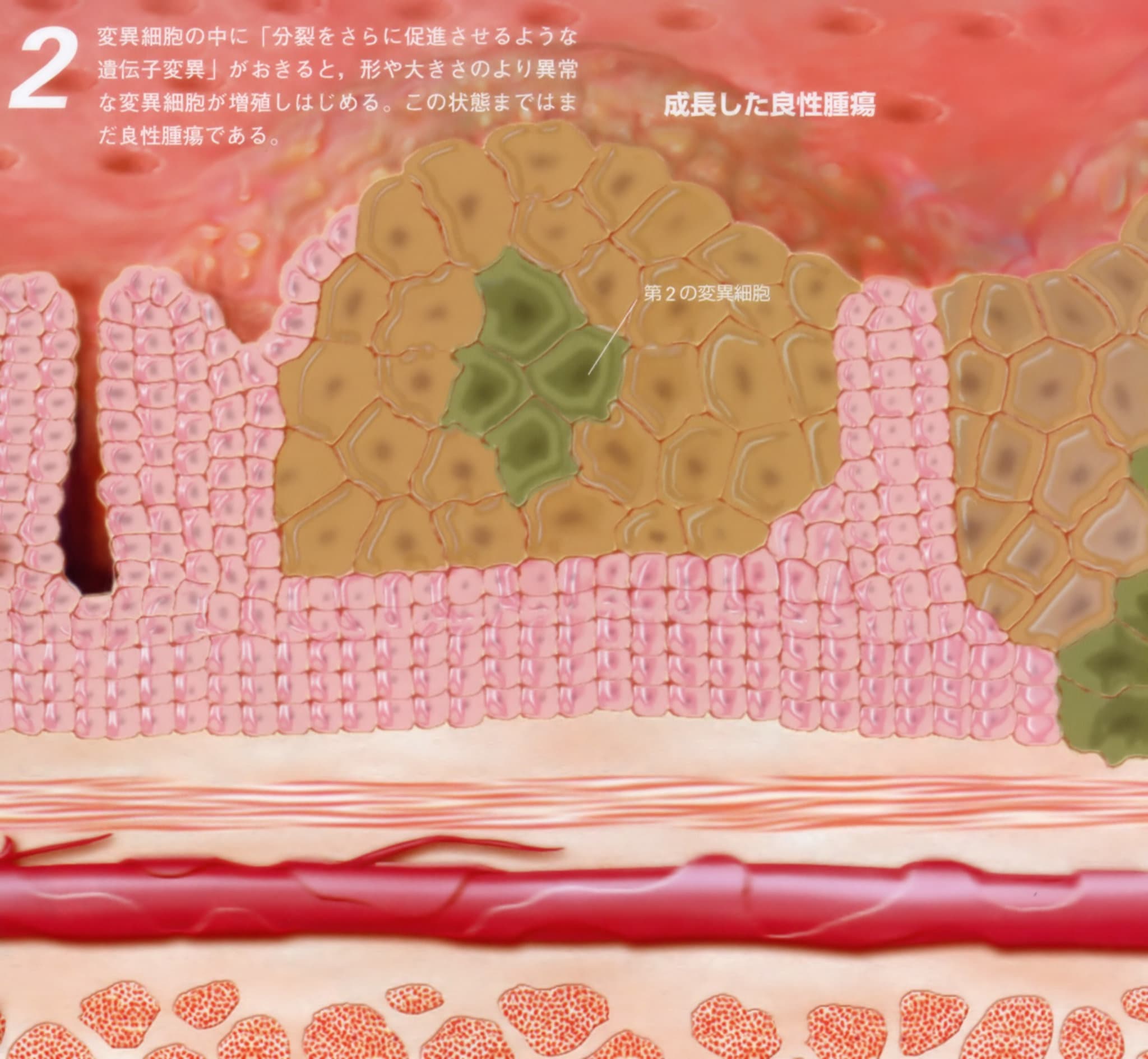 成長した良性腫瘍(末期癌からの生還)