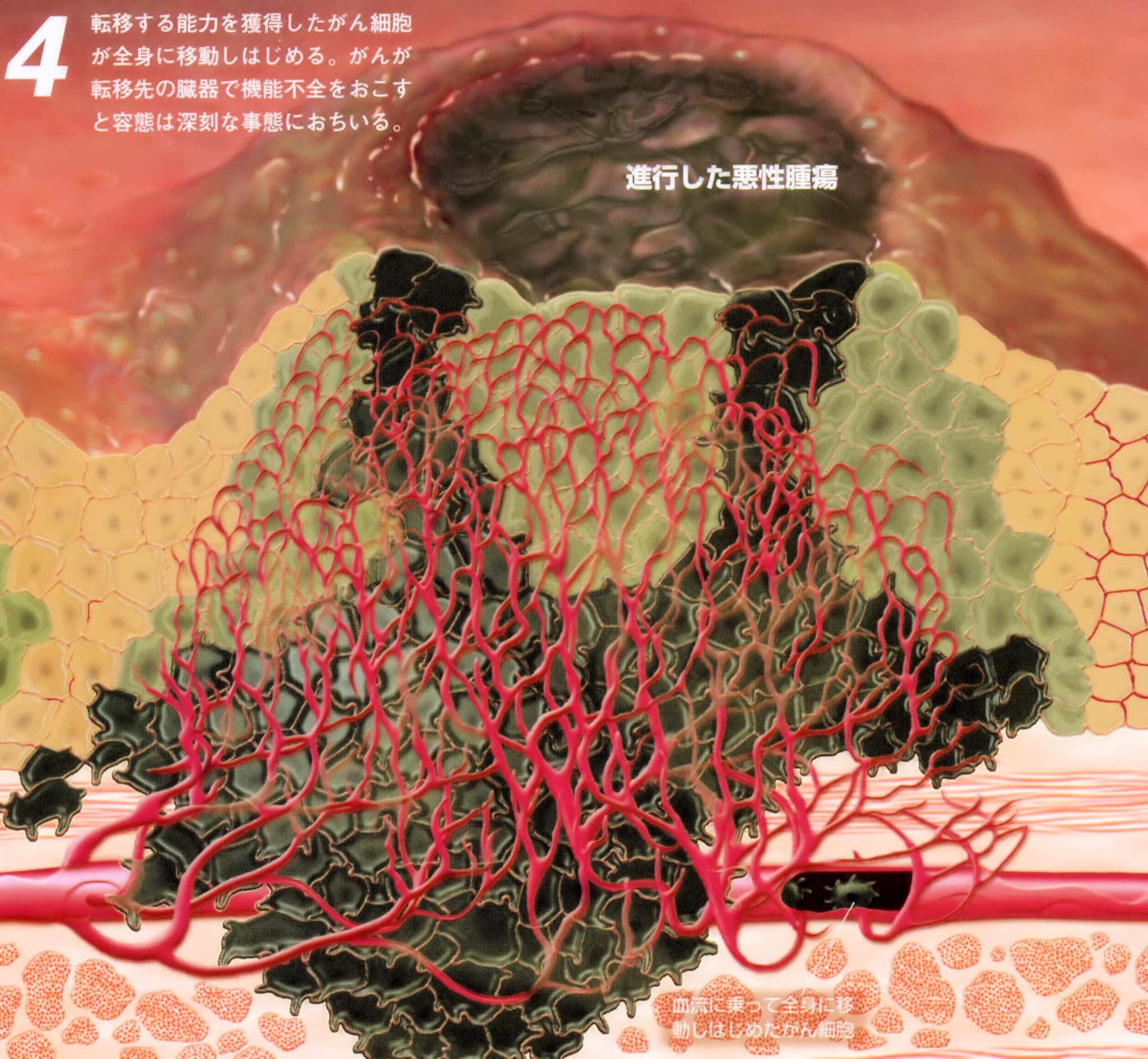 進行した悪性腫瘍「癌」(末期癌からの生還)