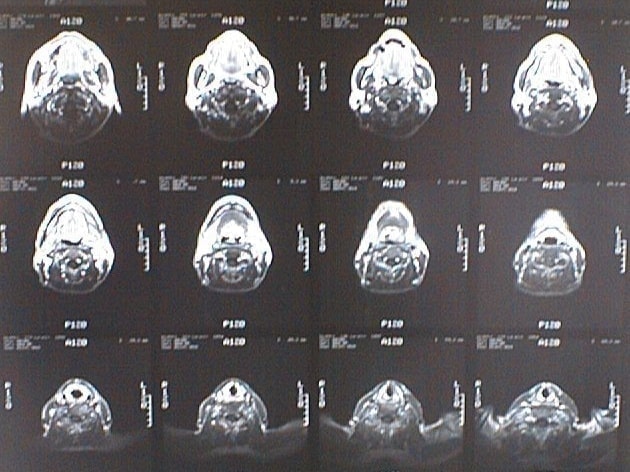 中咽頭末期がんMRI画像①