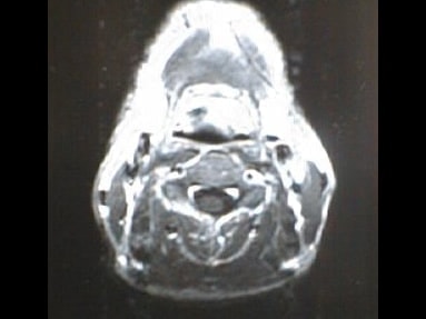 中咽頭末期がんMRI画像②