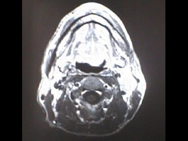 中咽頭末期がんMRI画像③