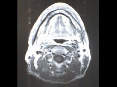 中咽頭末期がん消滅時MRI画像③