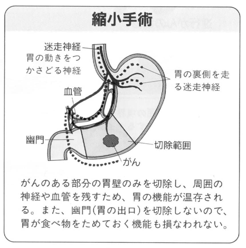 胃がんの縮小手術とは