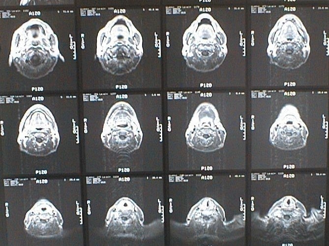 中咽頭末期がん消滅時MRI画像①
