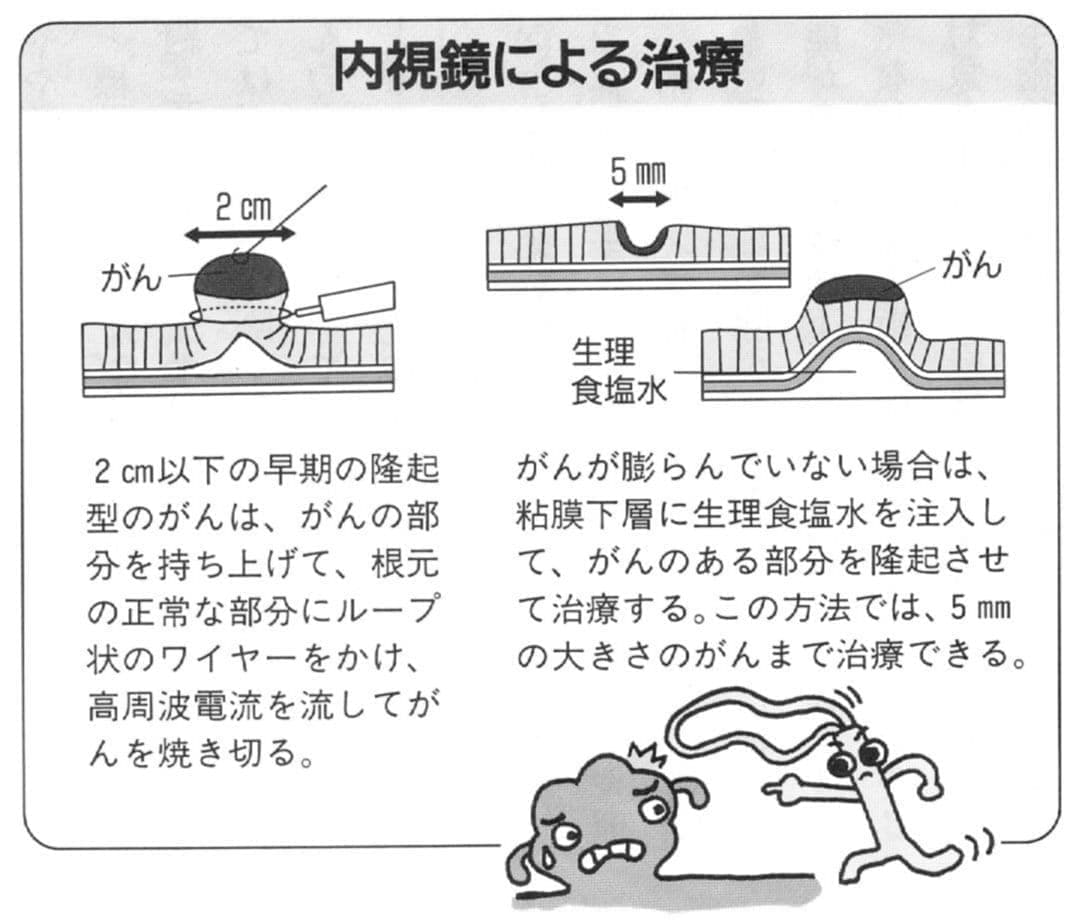 内視鏡による胃がん治療