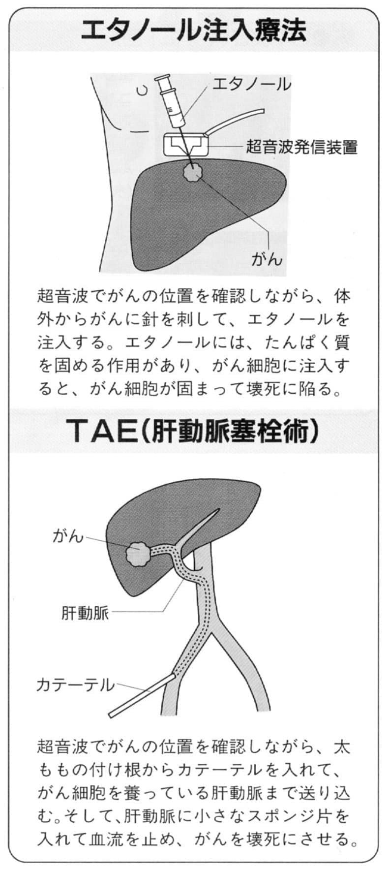 肝臓がんのエタノール注入療法とTAE肝動脈塞栓術