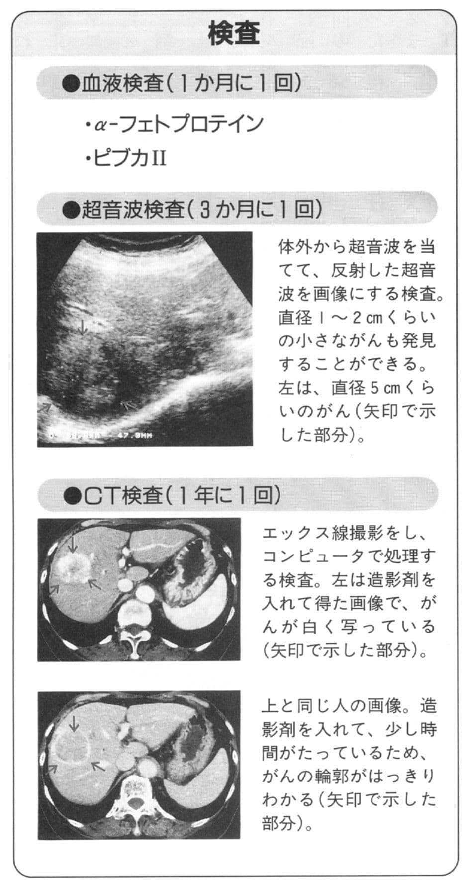 肝臓がんの検査