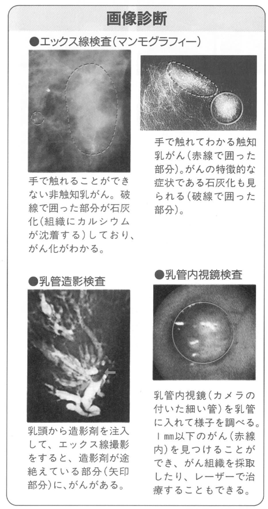 乳がんの画像診断