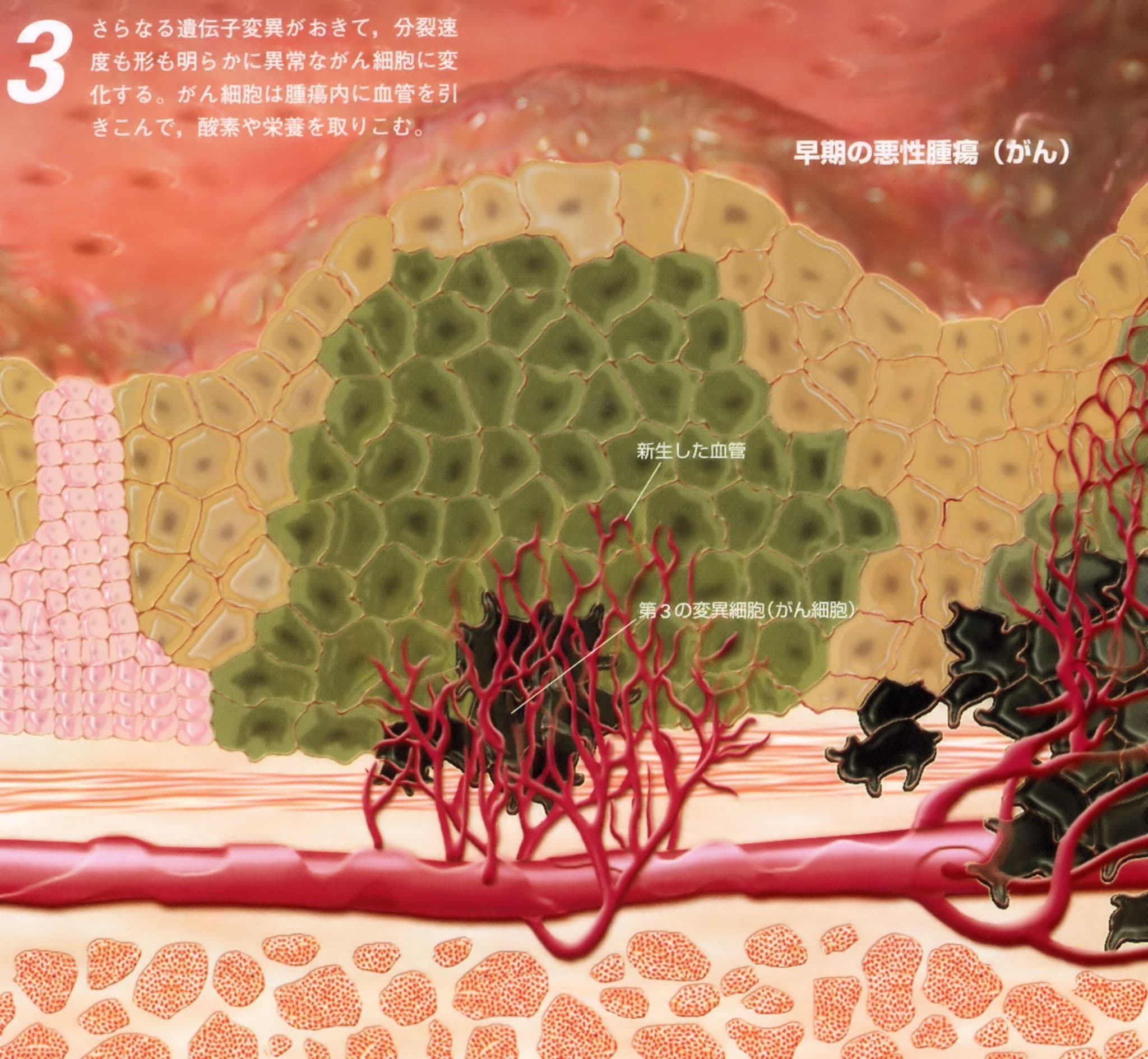 早期の悪性腫瘍「癌」（末期癌からの生還）